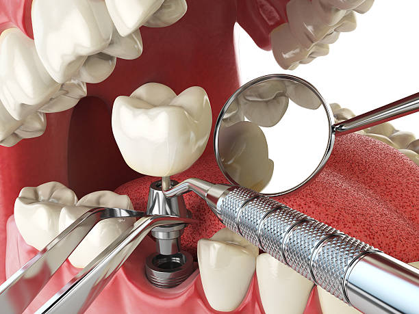 Best Emergency Dental Care for Broken or Chipped Teeth in Inverness, IL